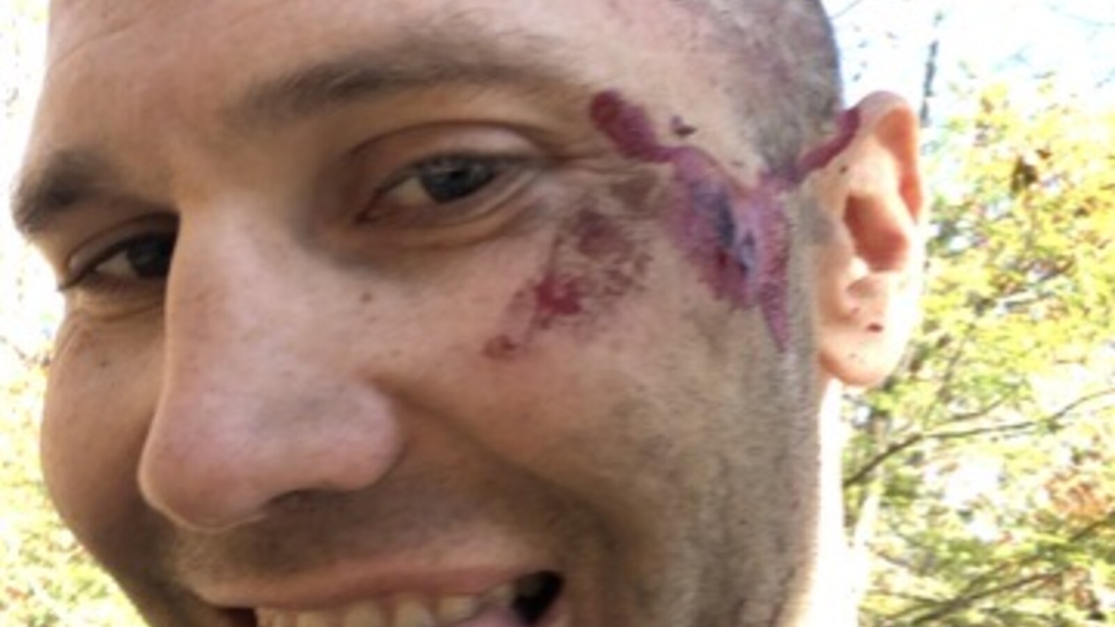 Chris smiling after a bicycle crash with scrapes and bruising along the left side of his face